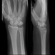 Image result for Lunate Dislocation
