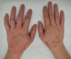 Image result for dermatitis contacta