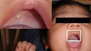 What are the features of a baby mouth? Epstein Pearls Symptoms Pictures Causes And Treatment