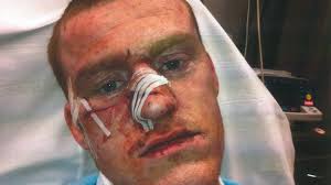 Résultat de recherche d'images pour "knife injuries"