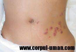Zona Zoster Herpes Zoster Boala Dermatologica