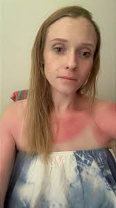 Ehlers-Danlos Syndrome and Increased Risk of Sunburns