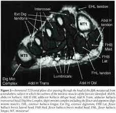 Learn about foot and ankle mri here. Intrinsic Muscle Atrophy And Toe Deformity In The Diabetic Neuropathic Foot A Magnetic Resonance Imaging Study Pathophysiology Complications Document Gale Academic Onefile