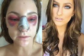 Its easy interface permits to use it everywhere we go. Rhiannongetsrhino Woman Shares Nose Job Selfies In Blow By Blow Account Of Her Cosmetic Surgery World News Mirror Online