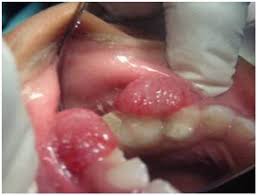 Image result for granuloma gum disease