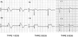 Brugada Syndrome Litfl Ecg Library Diagnosis