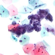 Penyebab penyakit ini adalah virus avipox. Gambar Penyakit Herpes Jenis Penyebab Gejala Dan Pencegahannya Hot Liputan6 Com