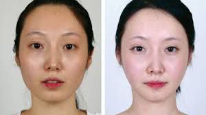 How much do the most popular plastic surgery procedures cost? V Line Surgery Cost Procedure And What To Expect