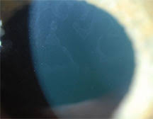 Epithelial basement membrane dystrophy (ebmd), is a disorder of the eye that can cause pain and dryness. Eyeworld Smoother Surfaces For Smoother Outcomes