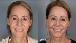 Facial Plastic Surgery