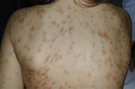 Image result for Urticaria pigmentosa children