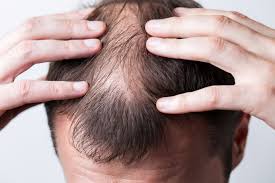 Regrowth hair loss due to radiation therapy can be temporary or permanent 1. Microrna Can Let Hair Grow Back Naturopathic Portal And Naturopathic Specialists