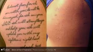 Aug 09, 2021 · dallas tattoo is a custom tattoo shop located in dallas, texas. Laser Tattoo Removal Treatments Lindon Orem