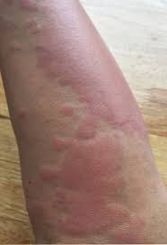 Image result for allergy rash on the legs