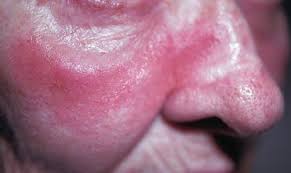 Image result for red rash face