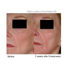 Before And After Laser Genesis To Full Face Acne Scar Diy Acne Scar Mask Skin Care Acne
