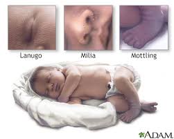 Babies normally exhibit mottled skin because of their immature circulatory system. Skin Findings In Newborns Information Mount Sinai New York