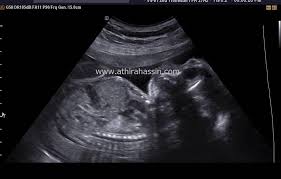 Boleh cuba servis itu di ultrasound 3d 4d. Beza Scan Baby 2d 3d 4d 5d Dan Hd Athirahassin