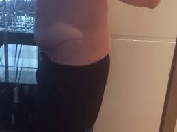 Probleme 4 Monate Nach Der Op Bauchstraffung Adipositas24 Community