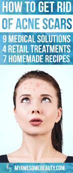 Strategies to get rid of acne will take time to work, so you must be regular and diligent in their application. How To Get Rid Of Acne Scars Fast The 20 Best Treatments And Tips