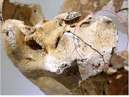 The sphenoid bone is an unpaired bone of the neurocranium. Sphenoid Bone With Notable Porosity Red Circle Download Scientific Diagram