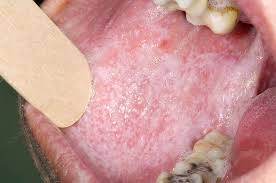 Image result for lichen planus on tongue)