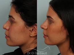 Cependant, les principaux objectifs de l'intervention sont les suivants maintenant que vous savez comment réduire l'inflammation du nez après une rhinoplastie, vous pouvez également vous intéresser à cet autre. Rhinoplastie Chirurgie Esthetique Du Nez Avis Chirurgien Esthetique