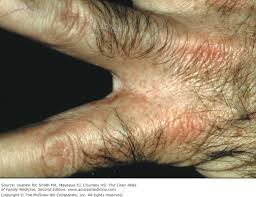 Image result for Tinnea vesiculosa