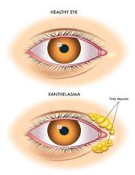 Image result for xanthelasma of eyelid