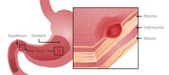 Stomach ulcer medical concept stomach ulcer medical concept and burning indigestion pain in the digestive system with a medical illustration of the human abdomen organ with a hole and a burn with smoke as a health care symbol in a 3d illustration style. Peptic Ulcer Disease Concise Medical Knowledge