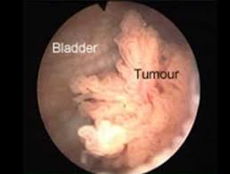 Image result for Bladder Cancer