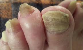 Image result for onychomycosis