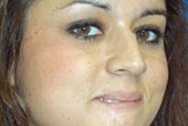 Hemangioma Treatment in Children