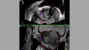 Cds may help identify an appropriate site for biopsy. Improving Prostate Cancer Diagnosis And Treatment Delivery With New Technology