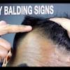 Dermatologists can distinguish between hair loss and hair shedding 1