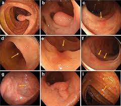 Colonoscopies are important because they can detect cancers while they're still treatable, and polyps (small growths) before they potentially develop into cancer. Development Of A Real Time Endoscopic Image Diagnosis Support System Using Deep Learning Technology In Colonoscopy Scientific Reports