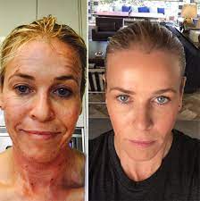 Network from 2007 to 2014, and delivered a narrative arrangement, chelsea does, on netflix in january 2016. Chelsea Handler S Anti Aging Treatment Will 3000 Laser Make You Look Younger Hollywood Life