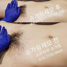 조혜진 원장은 회음부 제모는 개인의 특성에 맞춰 피부 톤. ì¸ì²œ ë¸Œë¼ì§ˆë¦¬ì–¸ì™ì‹± ì „í›„ ì‚¬ì§„ ë‚¨ìž ë¸Œë¼ì§ˆë¦¬ì–¸ì™ì‹± ì „ ì™ì‹± í›„