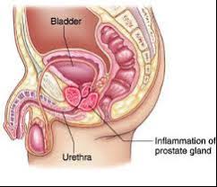 Image result for Chronic Bacterial Prostatitis