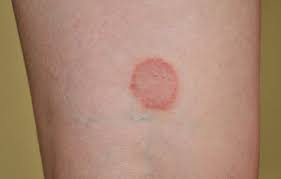 Ringworm Treatment Causes U S Dermatology Partners Ringworm is also referred to as 'tinea' and is in fact part of large group. ringworm treatment causes u s