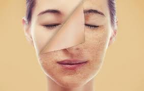 Kalau kulit wajah berminyak bisa disamarkan dengan make up yang bersifat matte, kulit kering justru sangat sulit disamarkan dengan make up, apalagi jika kulit keringmu sampai mengelupas. Kulit Wajah Kering Bisa Diatasi Dengan 5 Langkah Mudah Ini