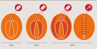Resultado de imagen para mutilacion genital