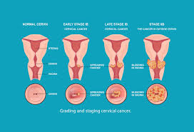 Image result for Friable Cervix