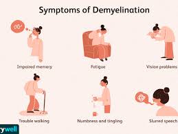 A demyelinating disease is any disease of the nervous system in which the myelin sheath of neurons is damaged.1 this impairs the. Demyelination Symptoms Causes Diagnosis Treatment