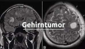 Schockdiagnose Gehirntumor Symptome Arten Risiken Und Behandlungsmethoden Medizin Fitness Ernahrung
