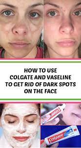 How To Use Colgate And Vaseline To Get Rid Of Dark Spots On The Face She Made By Grace Dark Spots On Skin Brown Spots On Skin Brown Spots On Face