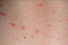 Chicken pox blog, recover easily from your chicken pox. Chickenpox Nhs