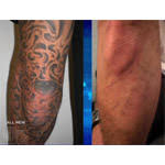 The only limitation is your imagination. 19 Tattoo Removal Boca Raton Providers Laser Tattoo Removal Ahb