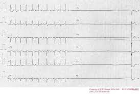 Sick Sinus Syndrome Electrocardiogram Wikidoc