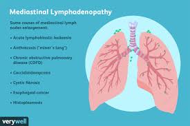 Chronic obstructive pulmonary disease (copd) is a term used to describe chronic lung diseases including emphysema, and chronic bronchitis. Mediastinal Lymphadenopathy